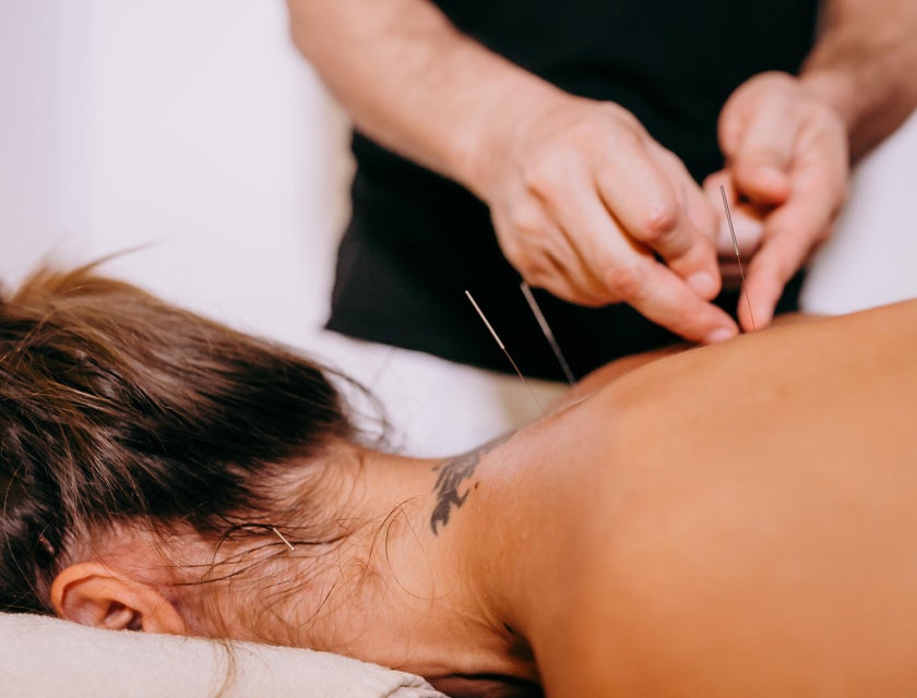 Acupuncturist treating the patient with the use of Acupuncture needles.